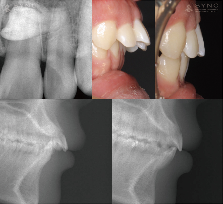 上顎前突（マウスピース型矯正装置 症例集） | 横浜の矯正歯科はSYNC