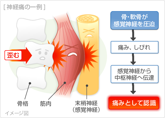 神経痛の症状・原因｜くすりと健康の情報局