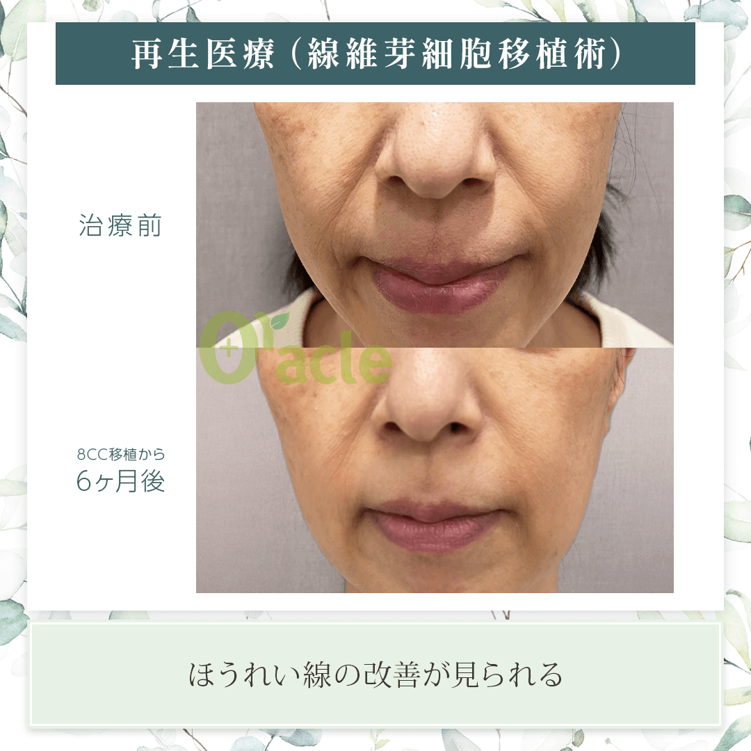 真皮線維芽細胞療法｜【公式】オラクル美容皮膚科