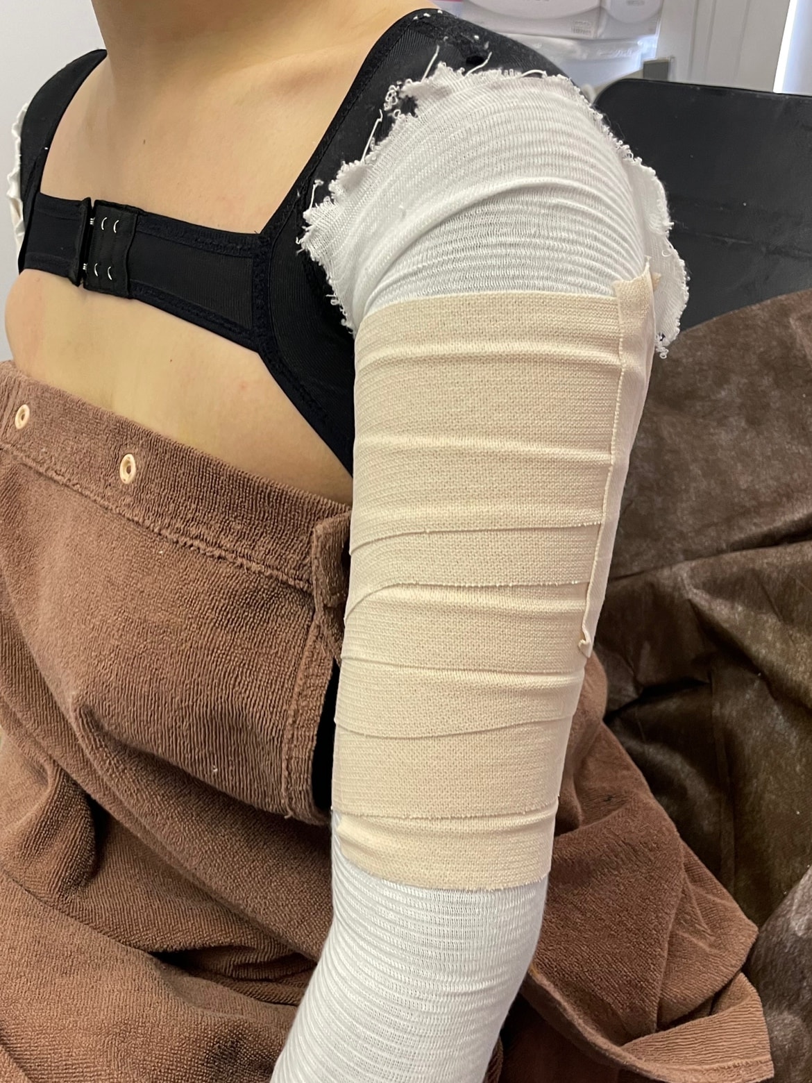 脂肪吸引のダウンタイム・圧迫・早く治す過ごし方【写真あり】 - 横浜院