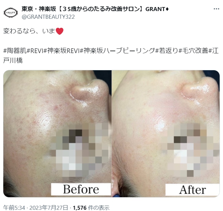 REVI(ルヴィ)ハーブピーリングの効果とは？効果なしと言われる理由や