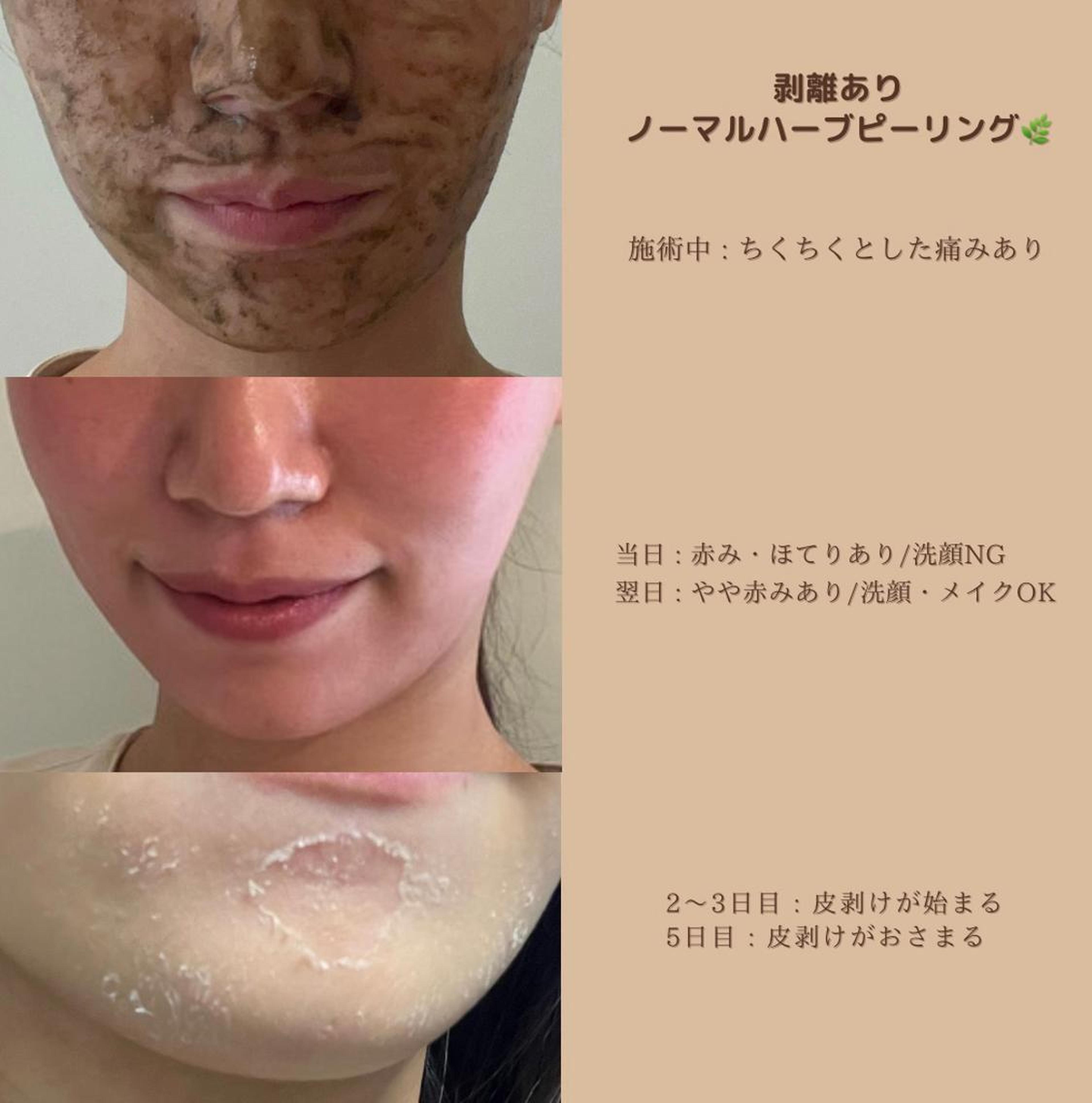 剥離ありハーブピーリングの流れです ノーマルハーブピーリングは