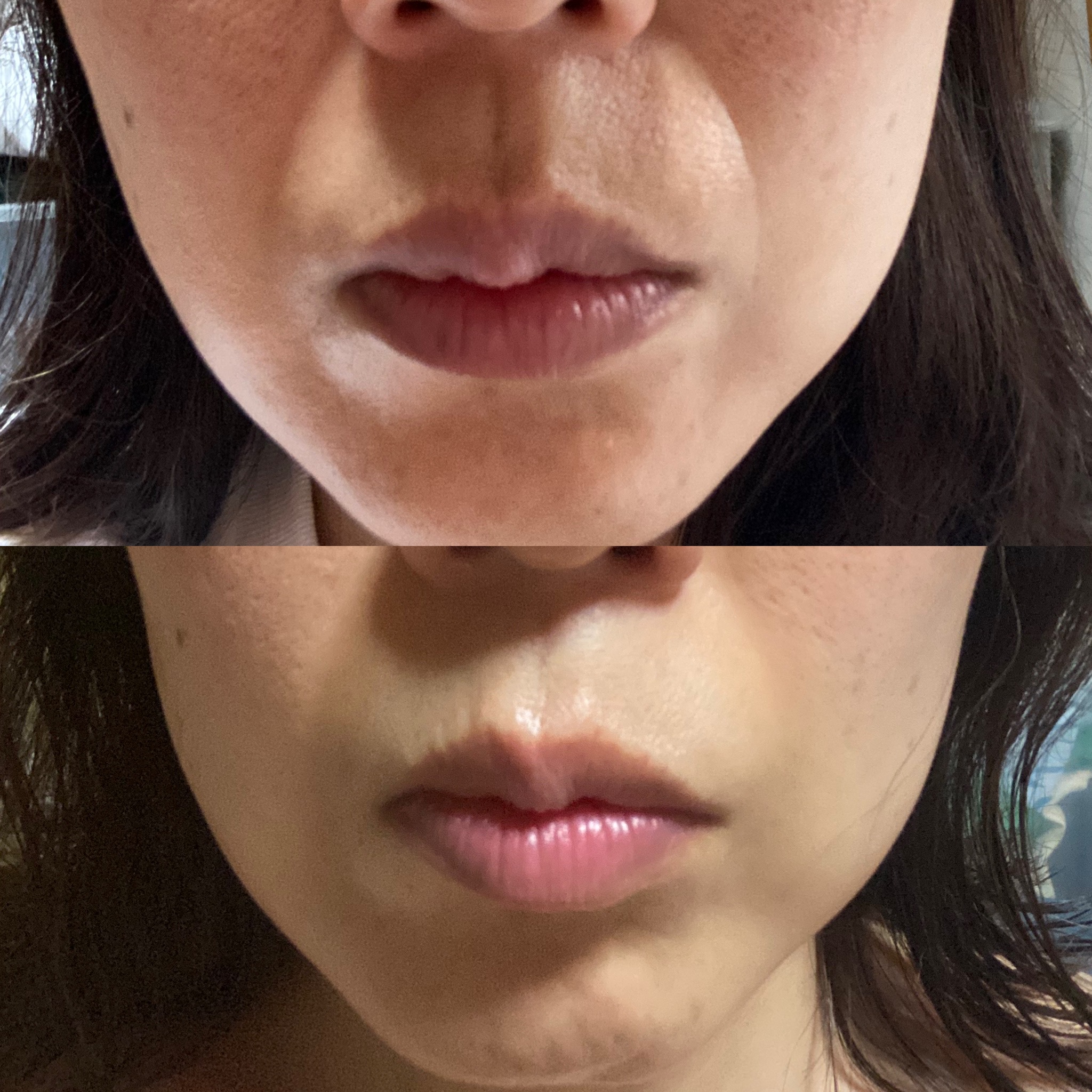 大人気！！肌ファスティング フェイスマスク&モリーズローラー | 敏感