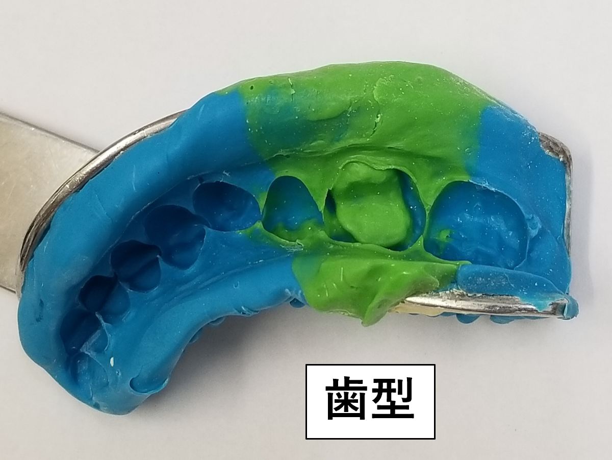銀歯から白いセラミックへ。見た目が変わり笑えるようになりました