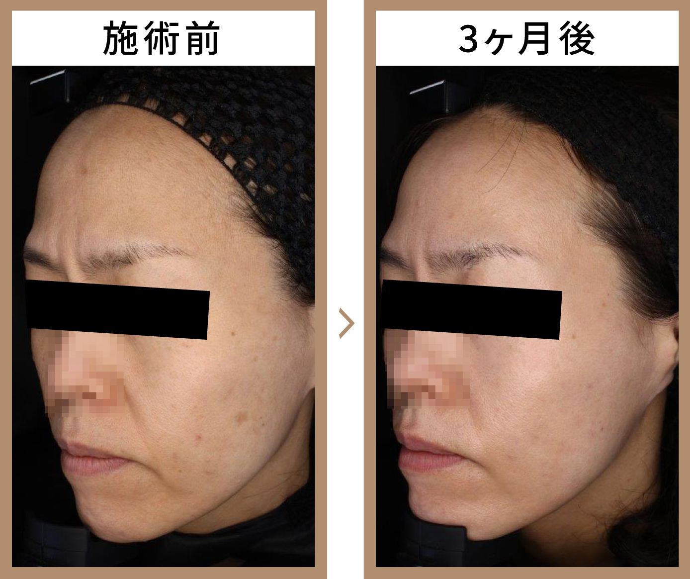 福岡天神のゼオスキンヘルスはケーズ皮膚科 美容皮膚科