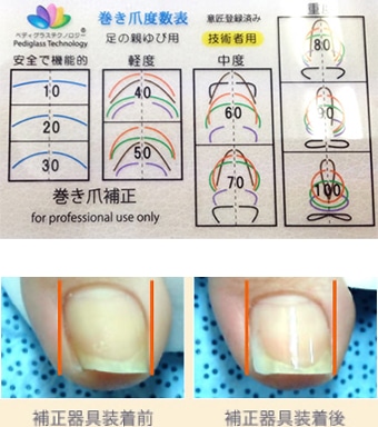 巻き爪ケアについて - 巻き爪補正・フットケア専門店 HISHO