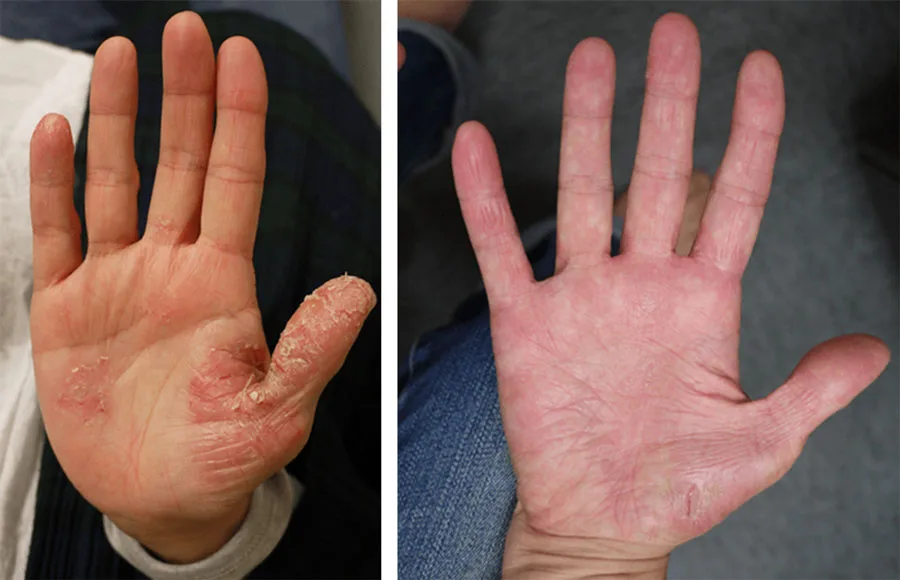 掌蹠膿疱症 - 福岡のみらいクリニック %